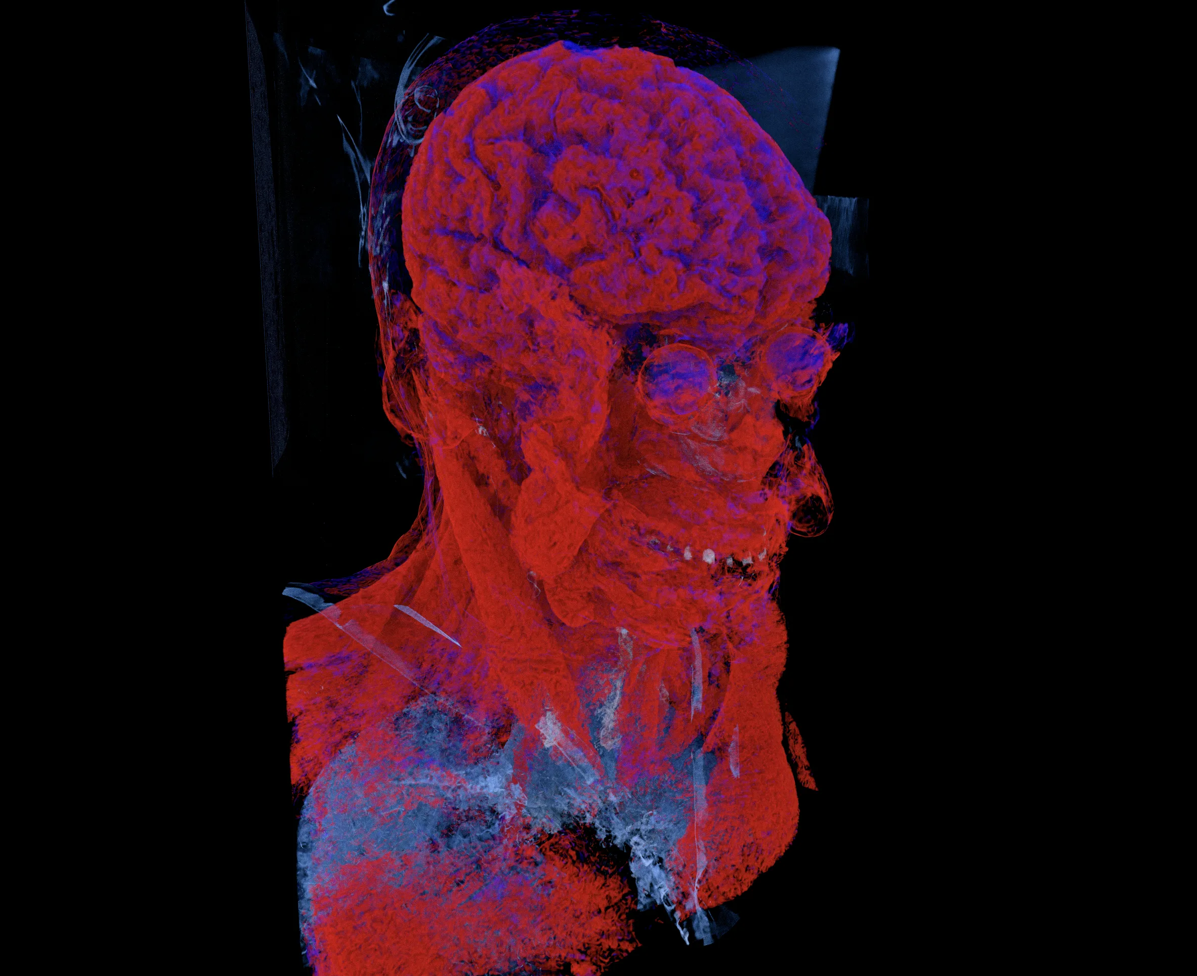 КТ головы MANIX в 3D с красной объёмной визуализацией мягких тканей