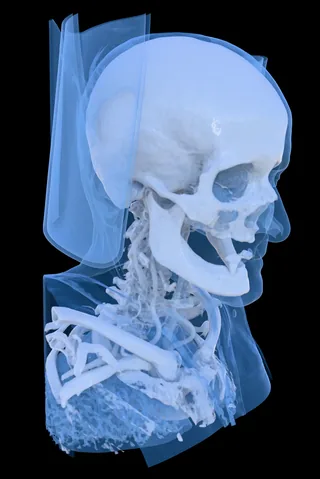 КТ черепа MANIX в 3D с синим костным пресетом сбоку