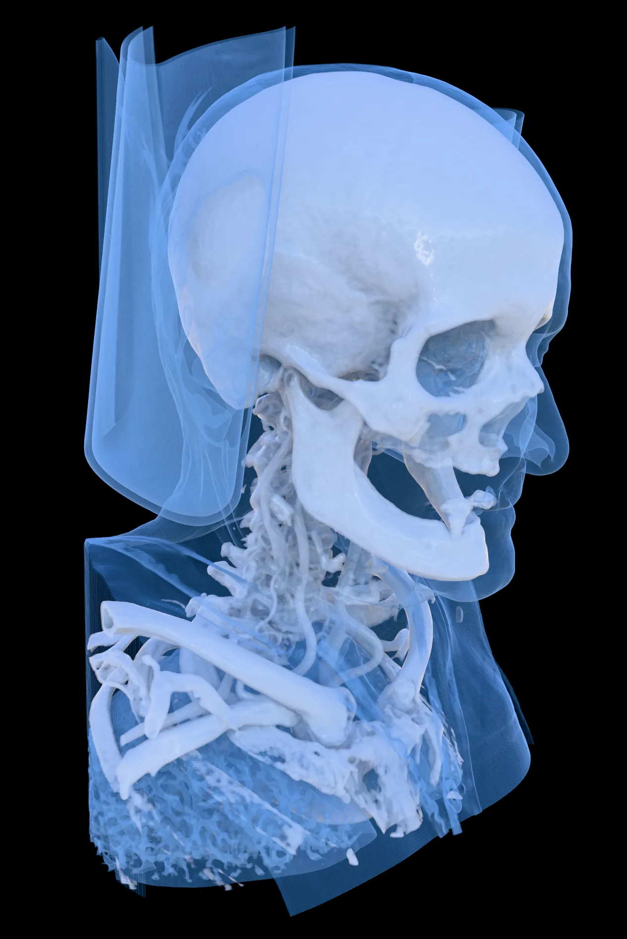 КТ черепа MANIX в 3D с синим костным пресетом сбоку